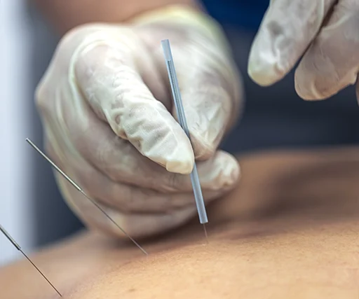 Subcision (Fibrous Tissue Release)